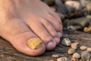 Nagelpilz: Ursachen, Vorbeugung und Behandlung – Der Ratgeber gegen "de Grind unner de Zehnäschel"